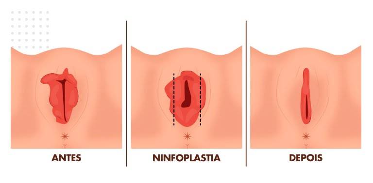 Ninfoplastia Sem Hospital Qual O Valor Em S O Paulo